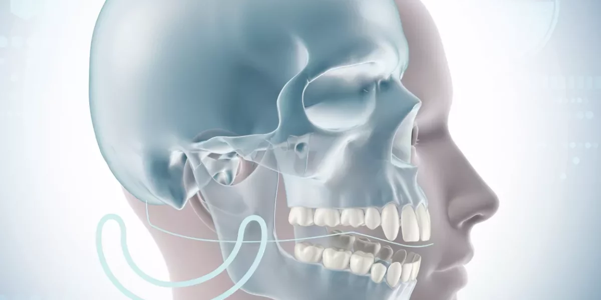 Can jaw narrowing cause crossbite?