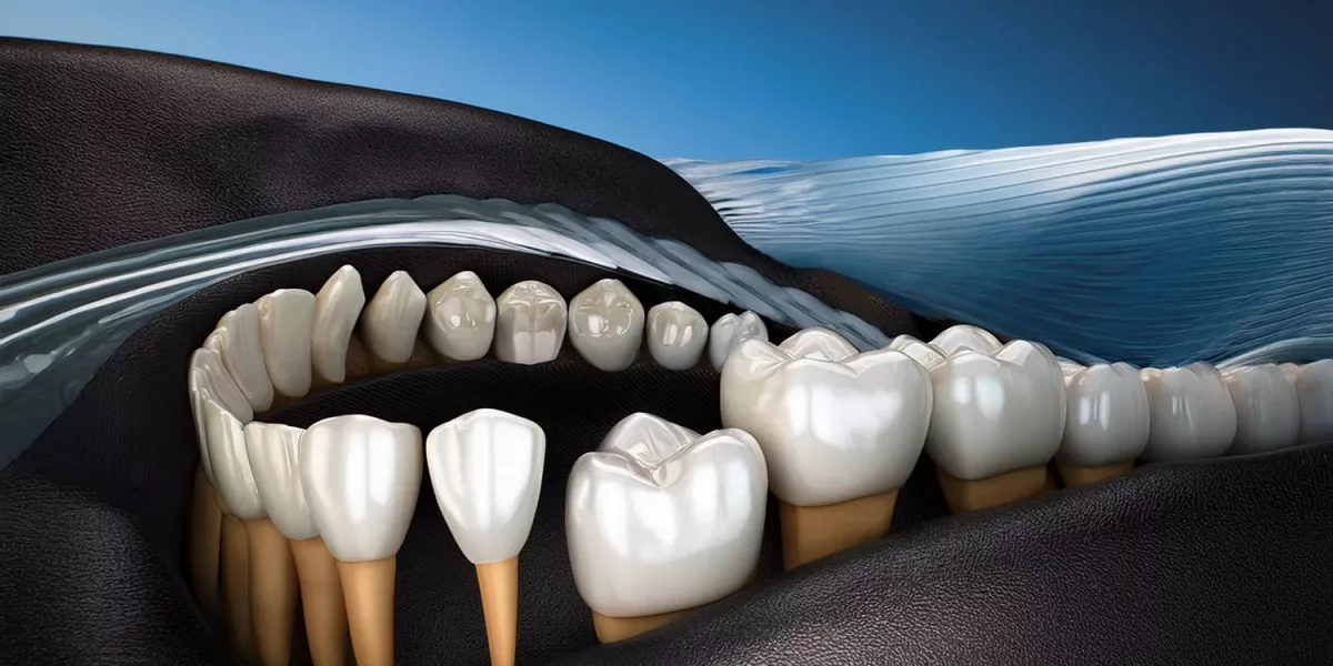 Large Fillings vs Zirconium Restorations