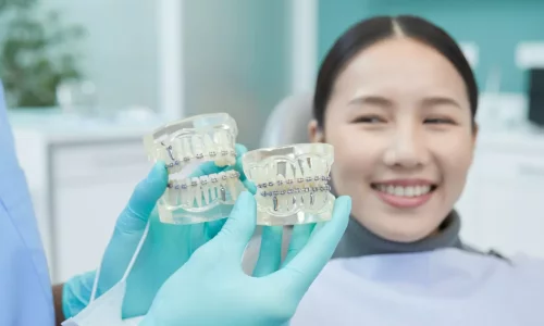 Are ceramic braces as effective as metal? - Milim Dental Hospital