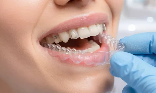 Attachment (Buttons) in Invisalign: What They Do and Why You Need Them - Milim Dental Hospital