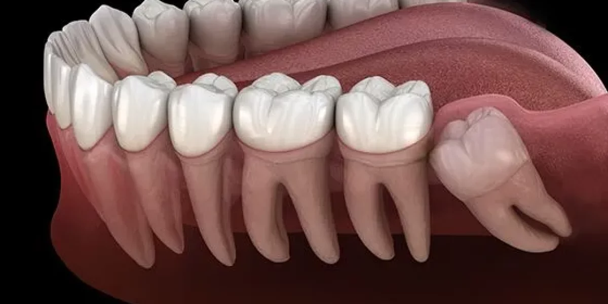 “Do Wisdom Teeth Always Need to Be Removed?” — The Honest Answer