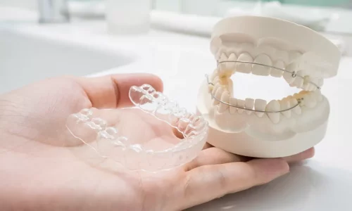Retainers After Orthodontics: Fixed vs Clear Retainers and How Long? - Milim Dental Hospital