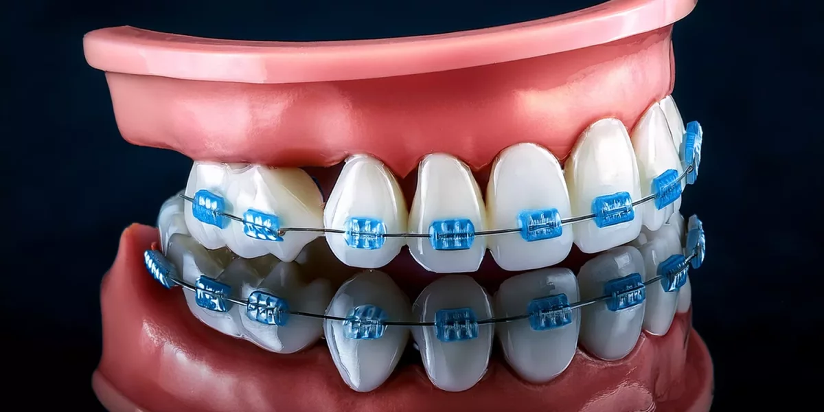 Straight Teeth, Healthy Jaws: Why Orthodontics Is Not Just About Looks