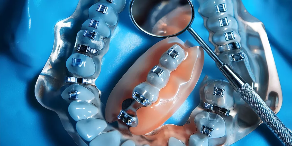 Înghesuirea ușoară a dinților: chiar am nevoie de extracții sau doar de Invisalign?