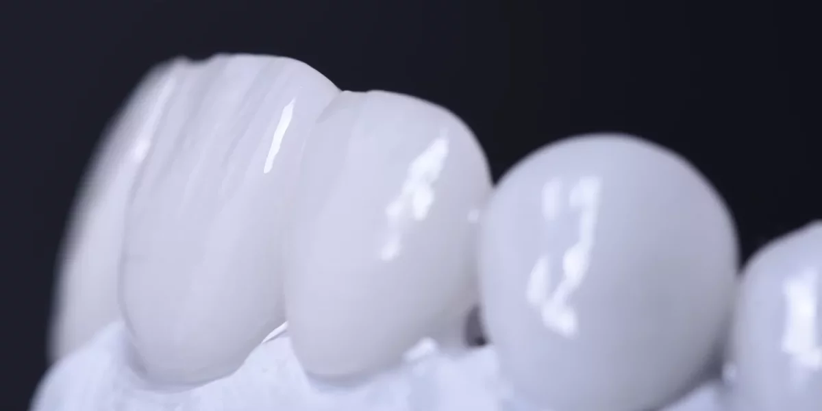 Emax vs Zirconia: Which Looks More Natural in Daylight? (Dutch Perspective)