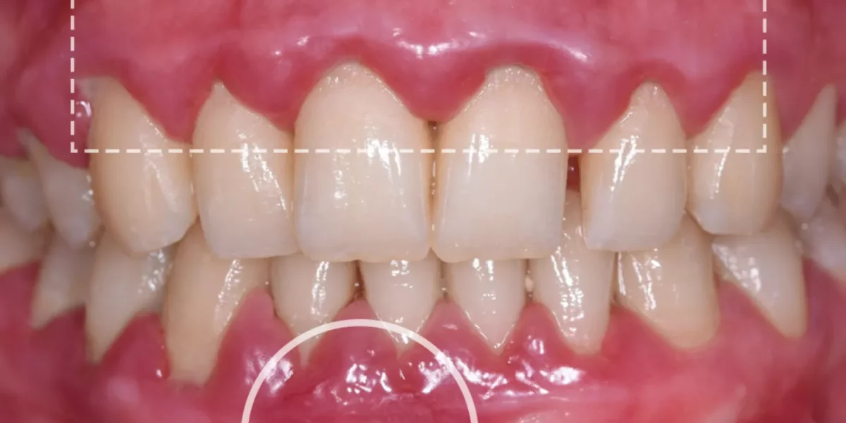 Boala gingiilor, sângerarea gingiilor și cum să-ți salvezi dinții