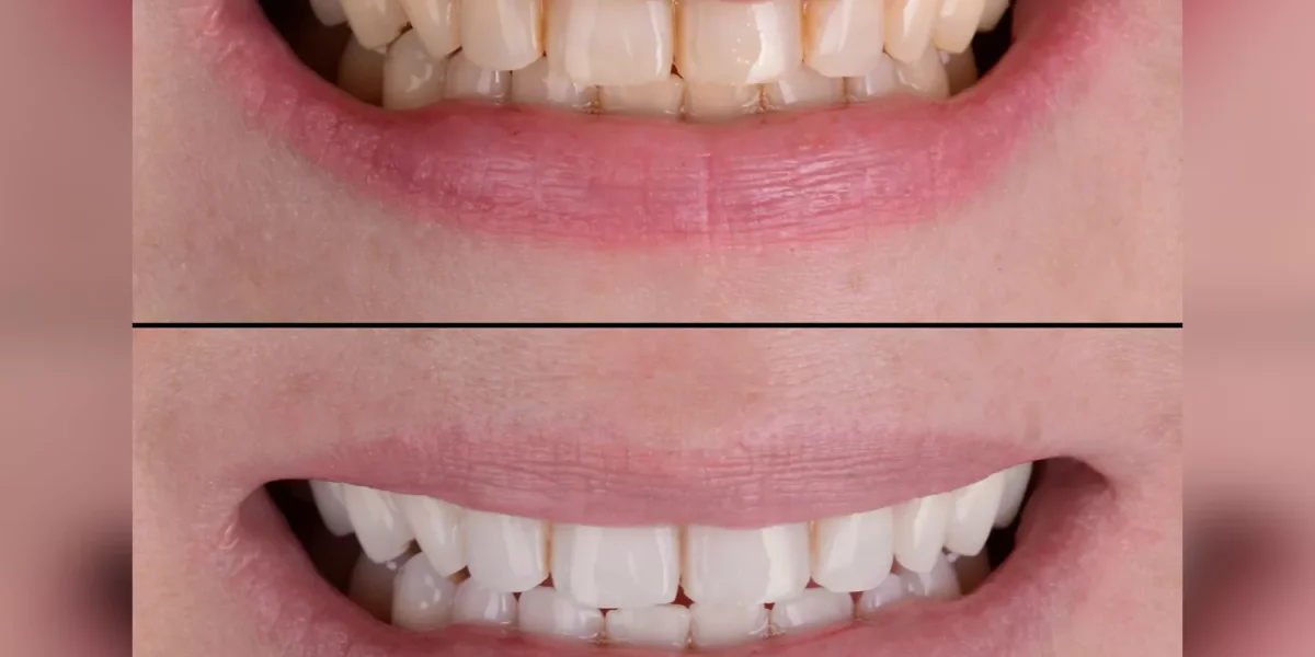 Your Complete Guide to Everyday Oral Health – From Fillings to Whitening