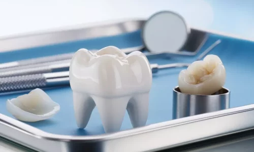 Long-Term Maintenance (Veneers & Crowns) - Milim Dental Hospital