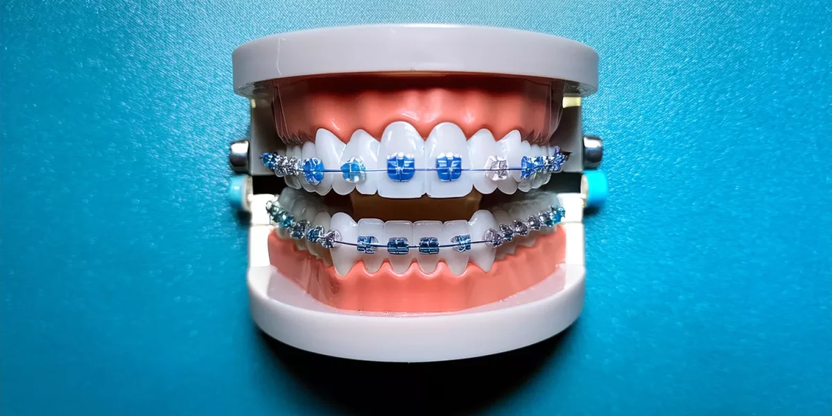 Am Nevoie Cu Adevărat De Aparat Dentar Sau Poate Invisalign Rezolva Înghesuirea Dentară?
