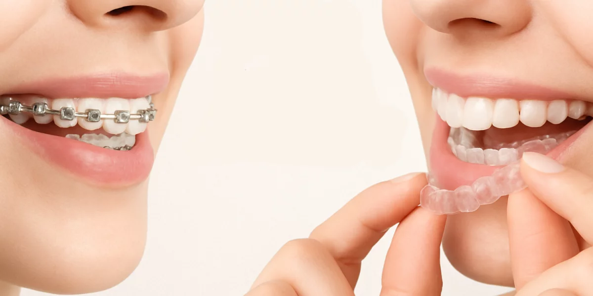 Braces or Invisalign?