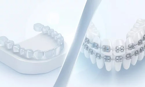 Which is faster: aligners or braces? - Milim Dental Hospital