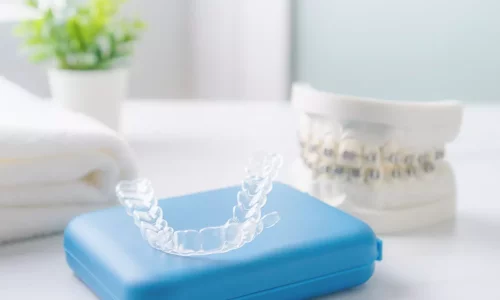 What retainer is used after ceramic braces? - Milim Dental Hospital