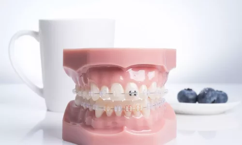 Do ceramic brackets stain? - Milim Dental Hospital