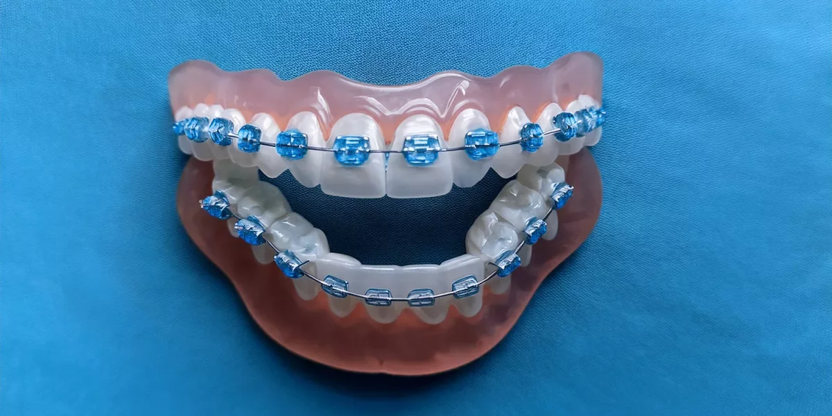 De ce este preferat Invisalign în locul aparatului dentar lingual?