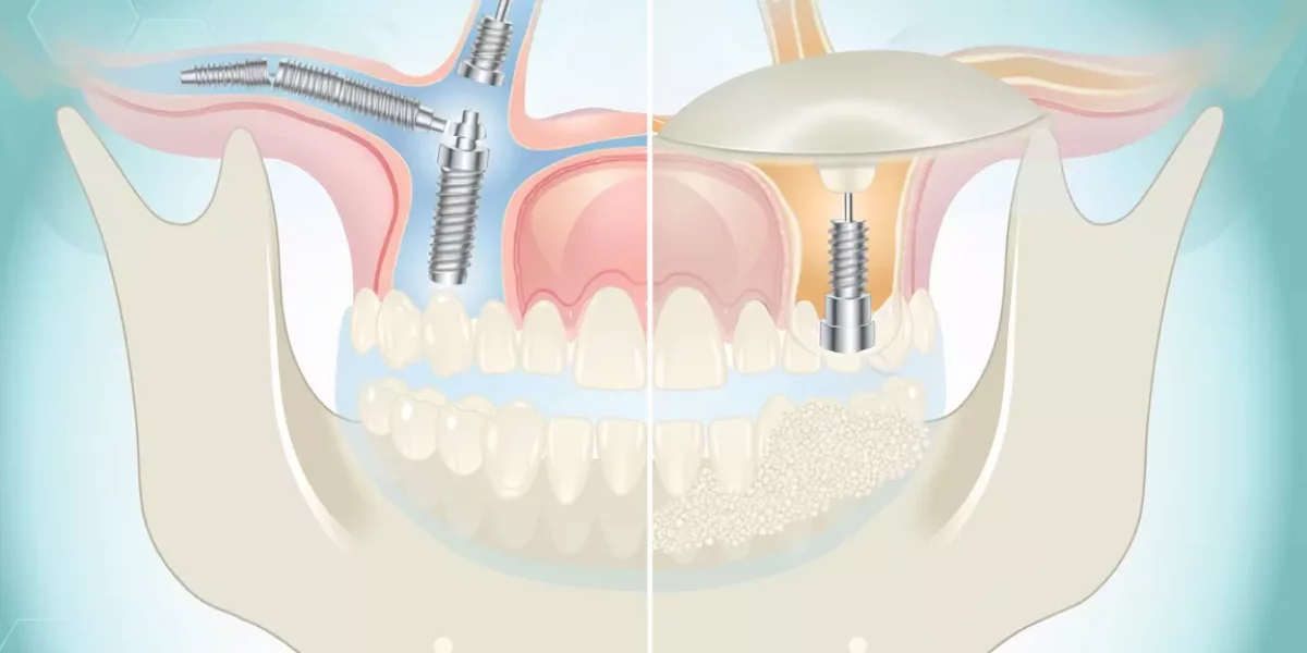 Zygoma Implants vs Sinus Lift