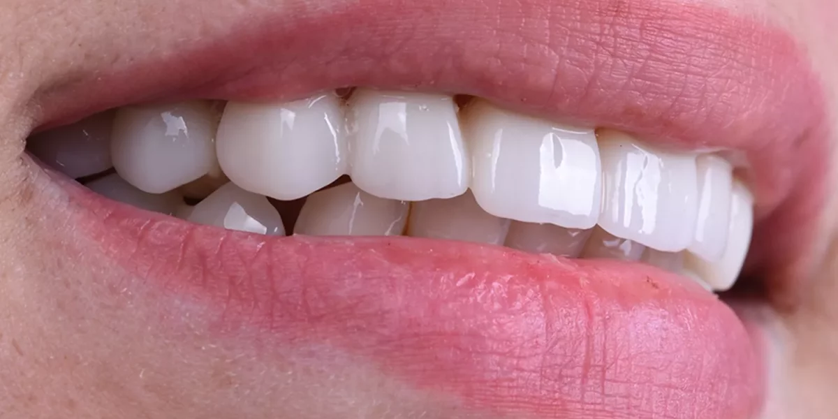  Hollywood Smile in Turkey: Why Expats in Bursa Choose MilimDental for Natural Aesthetic Smile Design