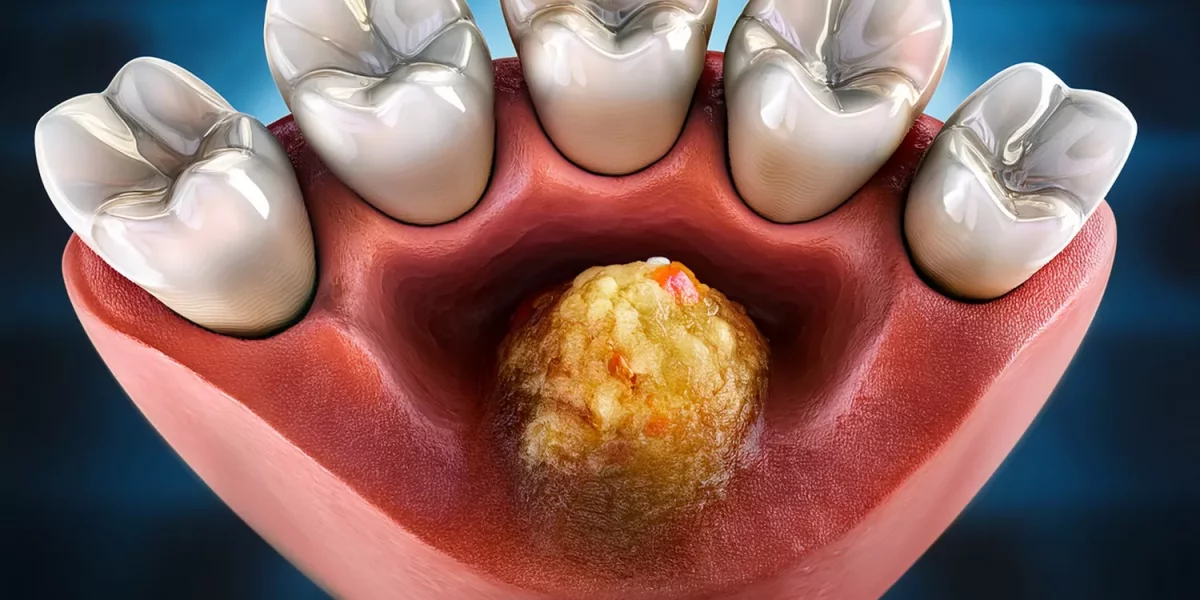 ? Persistent Abscess After Root Canal Treatment: What is Root End Surgery (Apical Resection)?