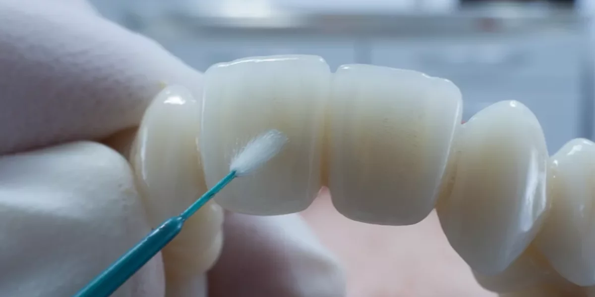 Veneer Bonding Protocol Longevity: What Makes Veneers Last