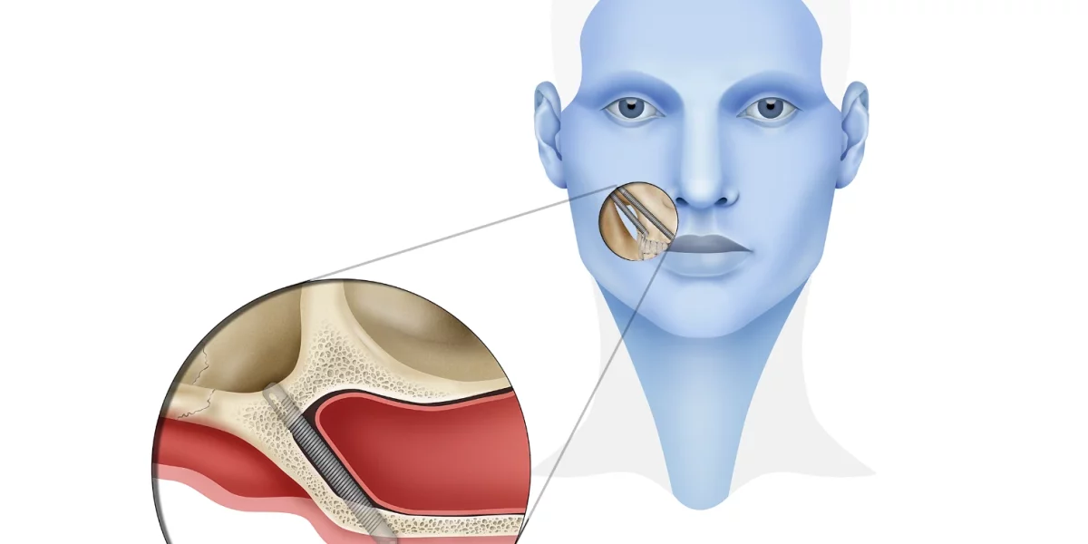 Beneficiile implanturilor zigomatice în cazurile de pierdere a osului
