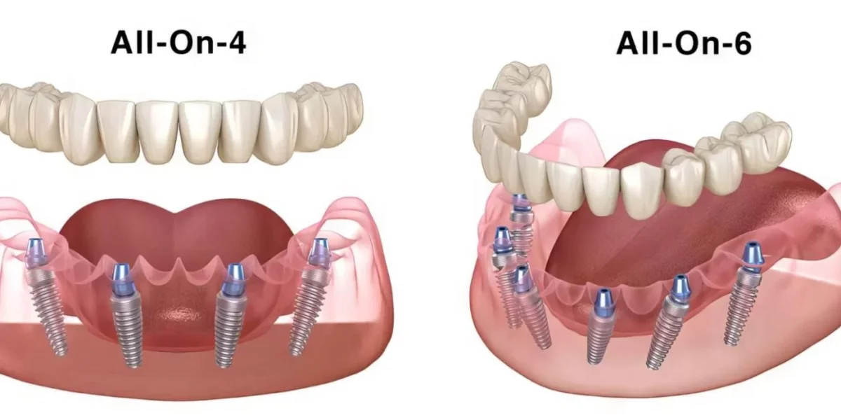 All-on-4 vs. All-on-X: Care este diferența?