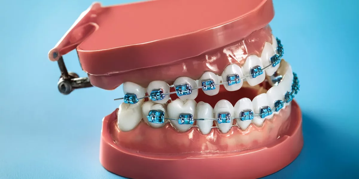 Ortodonție și Implanturi Dentare: De ce contează ordinea și momentul tratamentului