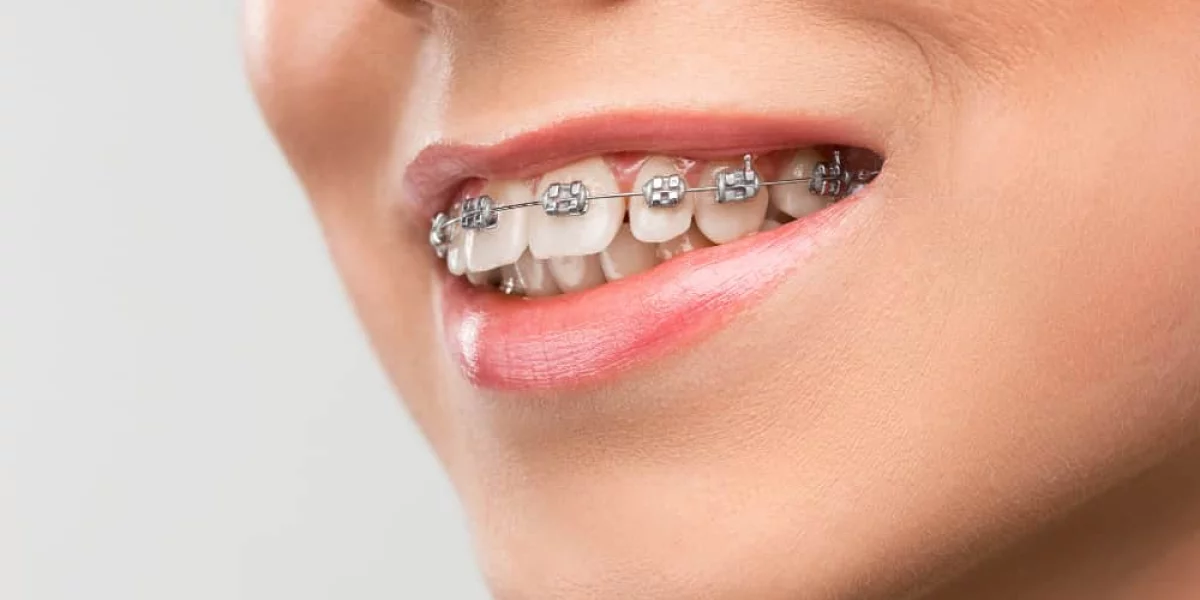 How Orthodontic Treatment Works