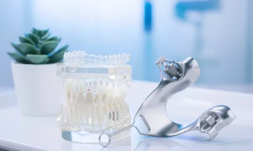 Can aligners help after expansion? - Milim Dental Hospital