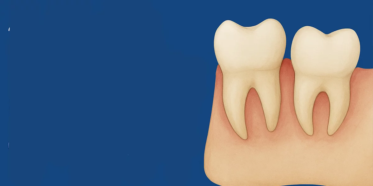 Extracția dinților de minte în Bursa: Trebuie să fie îndepărtați toți dinții de minte?