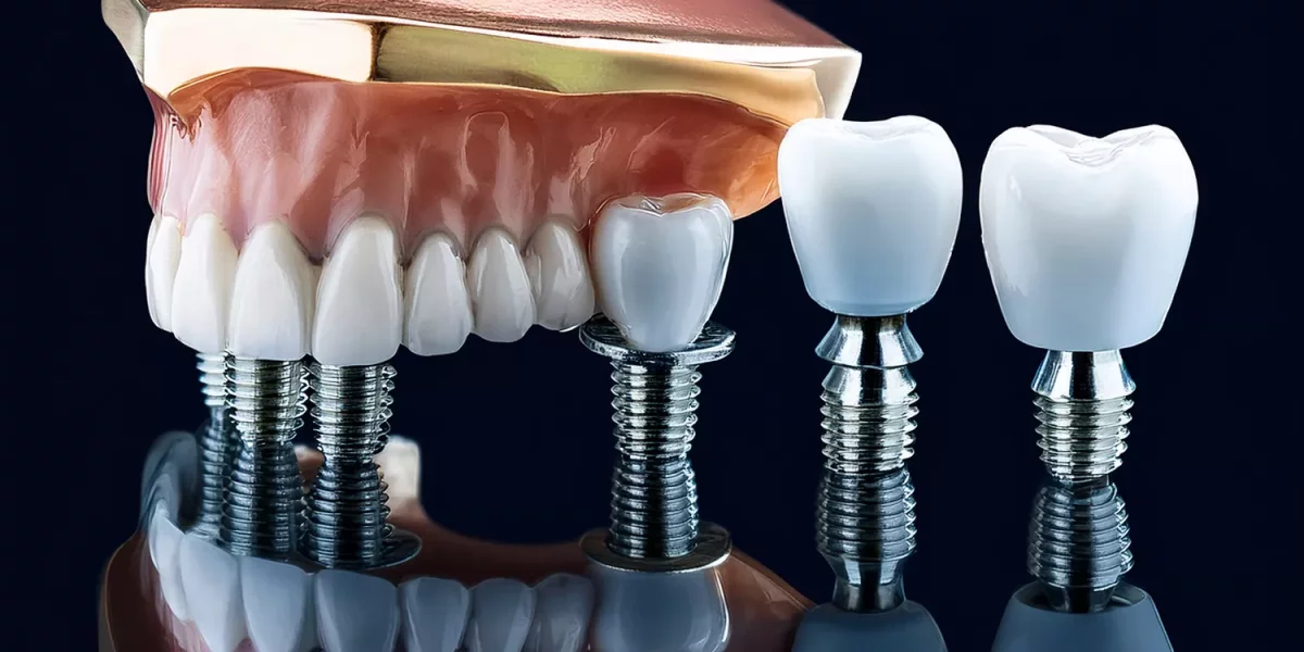 Îngrijirea pe termen lung a dinților pe implanturi