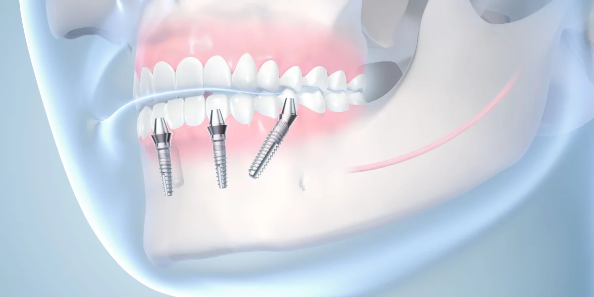 Îmbunătățire & Recuperare După All-on-4