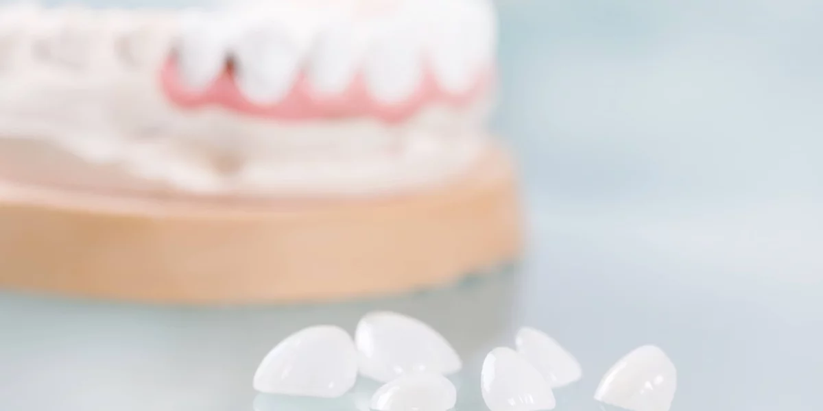 Cât timp durează fațetele dentare și cum să aveți grijă de ele?