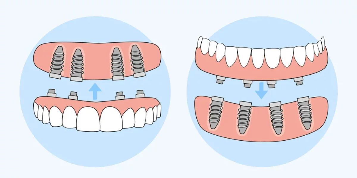 Restore Your Smile with All-on-4 Dental Implants in Bursa – A Life-Changing Solution by Milim Dental
