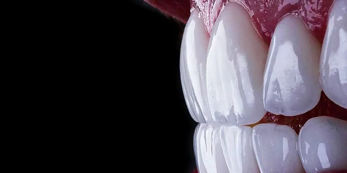 Strălucește Ca o Stea: Zâmbetul Hollywoodian cu Fațete E-Max la Milim Dental în Bursa