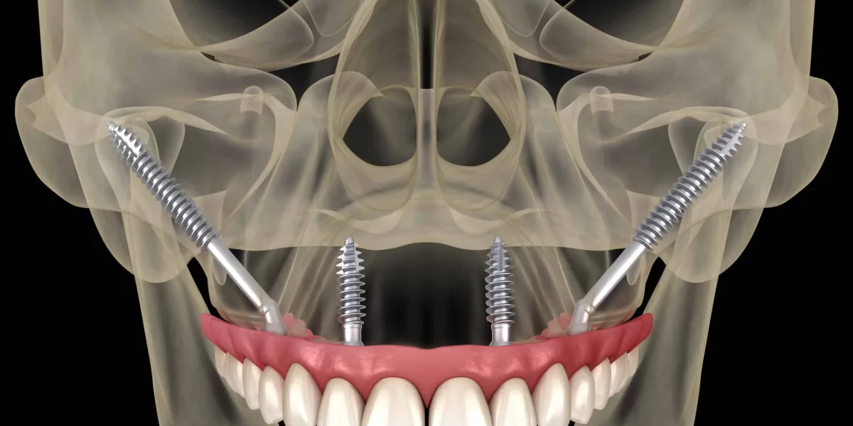 Avantajele All-on-X pentru pacienții cu pierdere de os