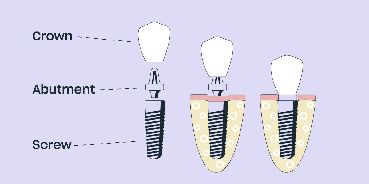 Procedura All-on-X: Ghid Pas cu Pas