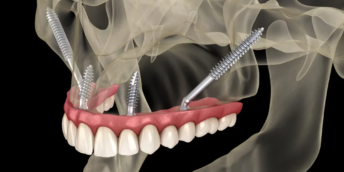 Procedura implantului zigomatic: intervenție chirurgicală și recuperare explicate