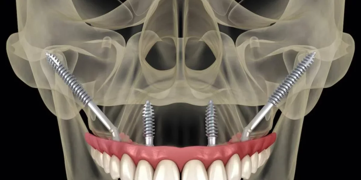 Cum se deosebesc implanturile zigomatice de implanturile tradiționale

