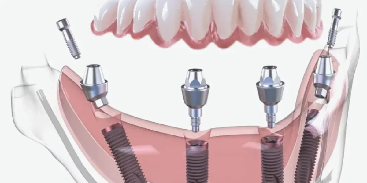 Ce este All-on-X și cum se deosebește de All-on-4?