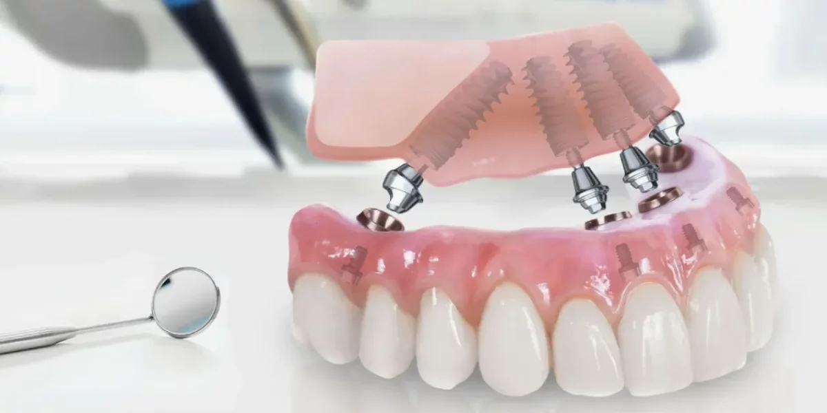 Ce este tehnica All-on-4?