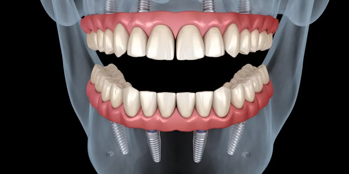 What Makes All-on-X a More Flexible Option for Full-Arch Restoration?