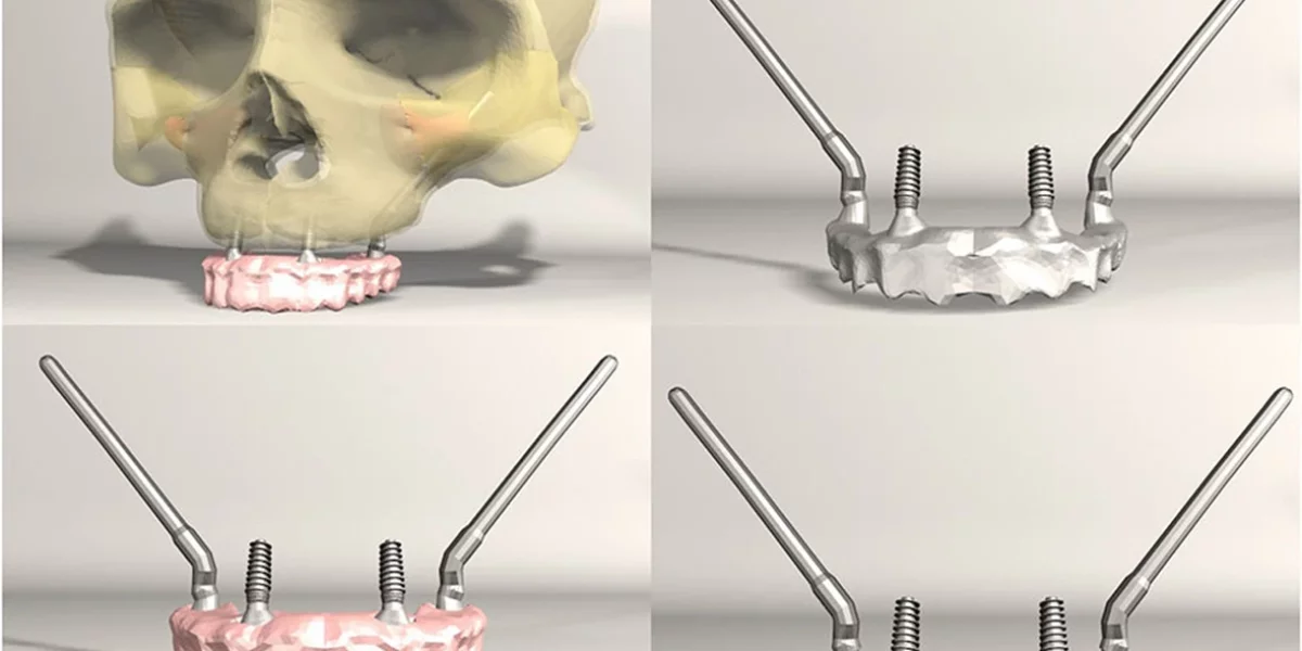 Când implanturile dentare par imposibile, implanturile zigomatice sunt soluția – doar la Milim Dental, Bursa