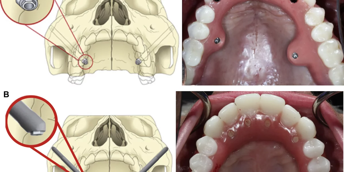Zygomatic Implants: A Lifesaving Solution for 