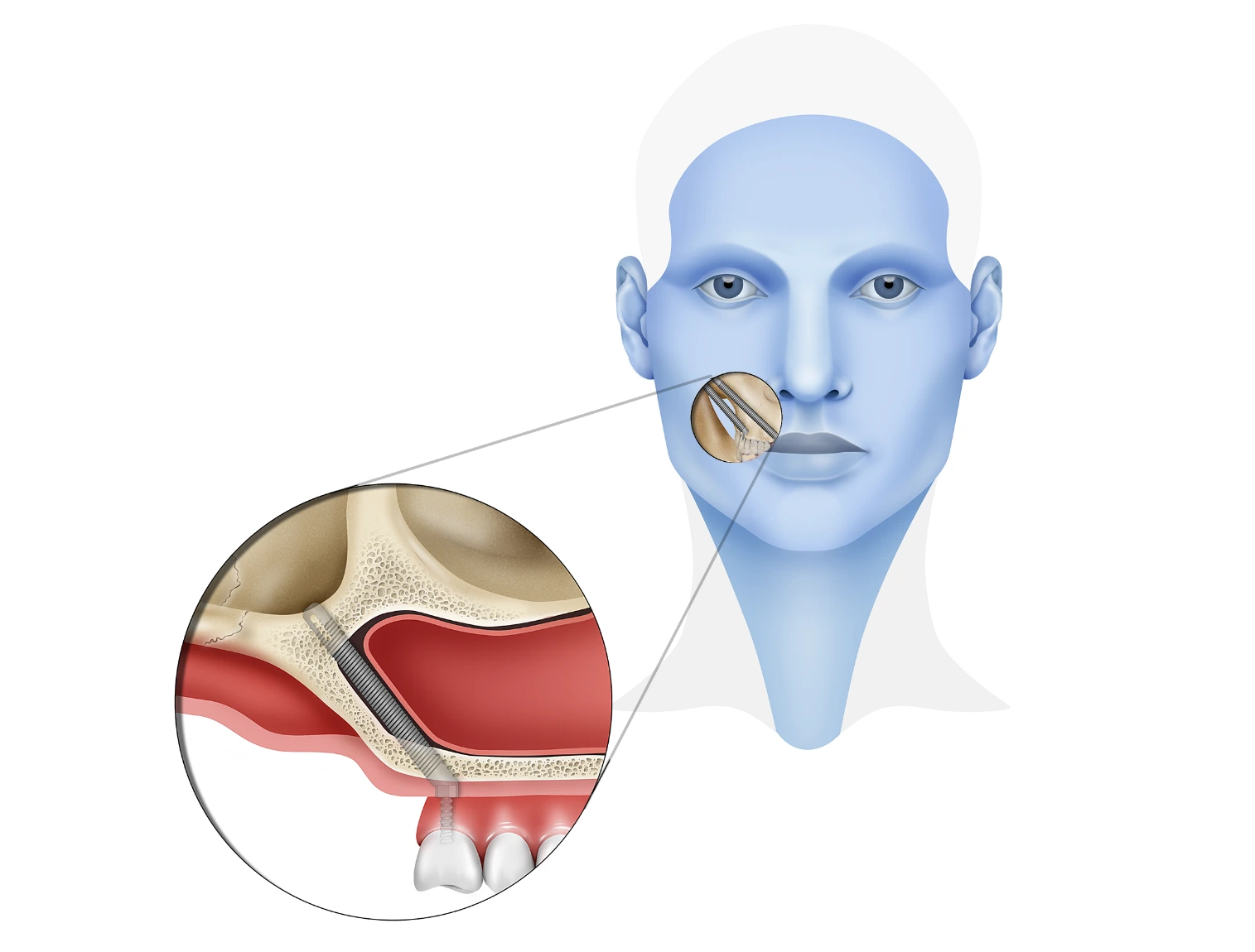The Benefits of Zygomatic Implants in Bone Loss Cases