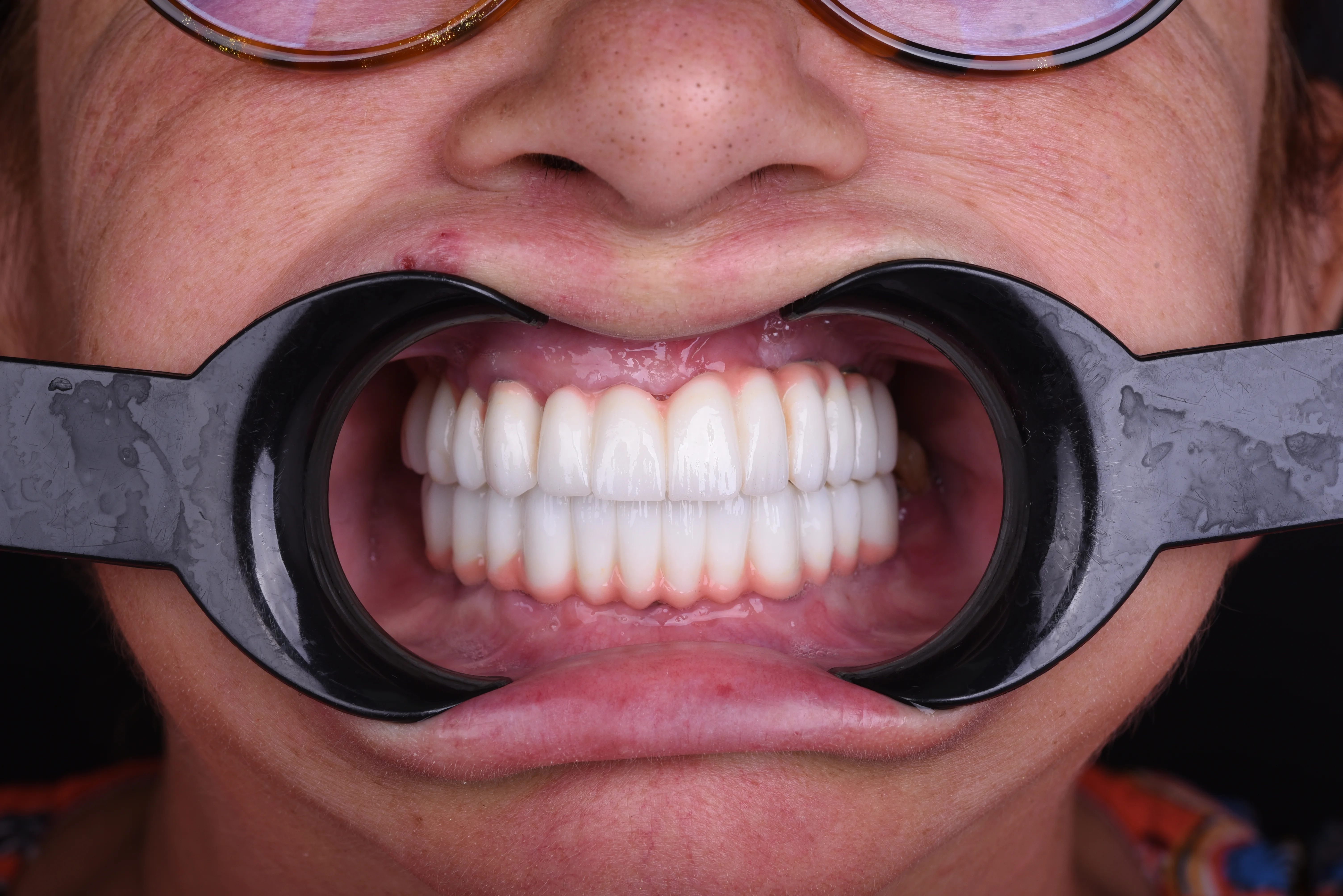 Full Mouth Restoration in Turkey: Regain Your Confidence