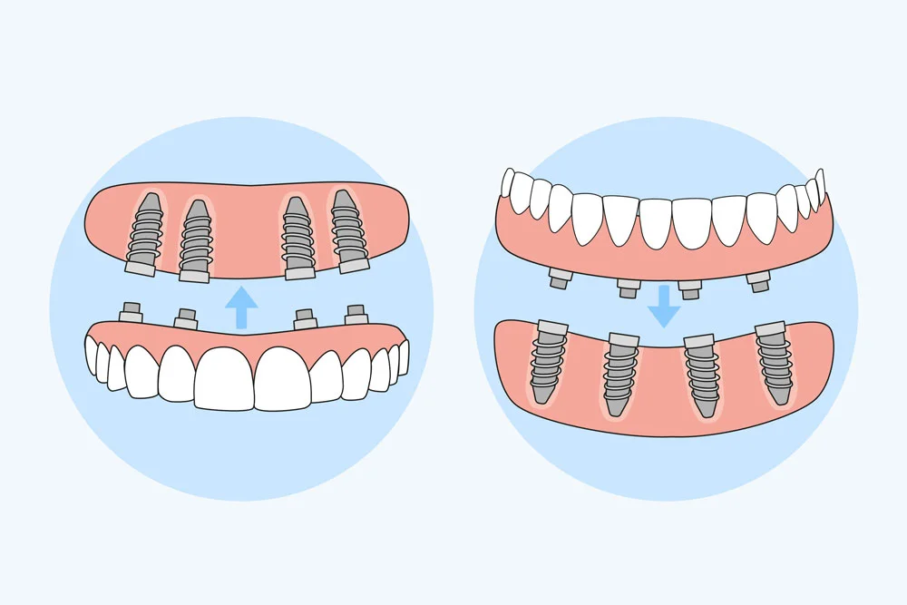 Restore Your Smile with All-on-4 Dental Implants in Bursa – A Life-Changing Solution by Milim Dental