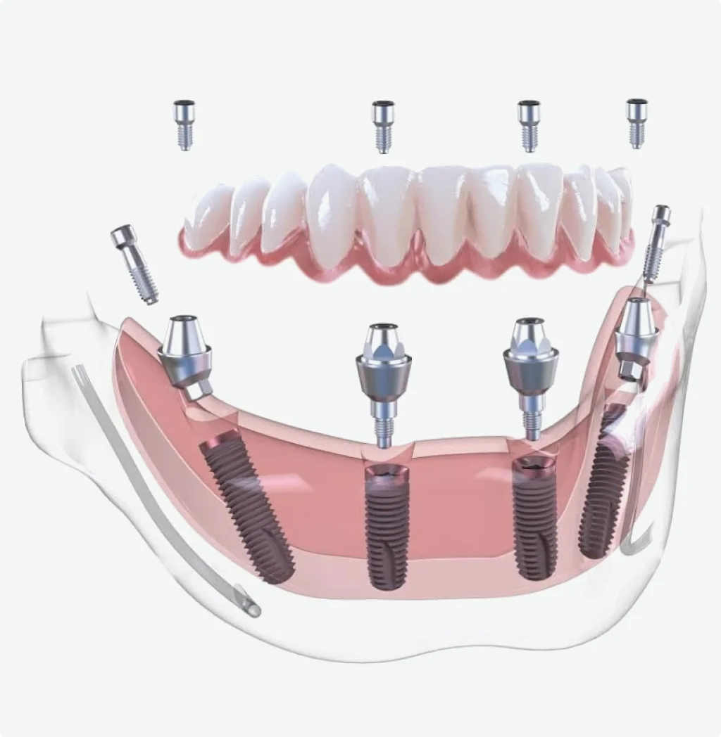 What is All-on-X and How Does It Differ from All-on-4?