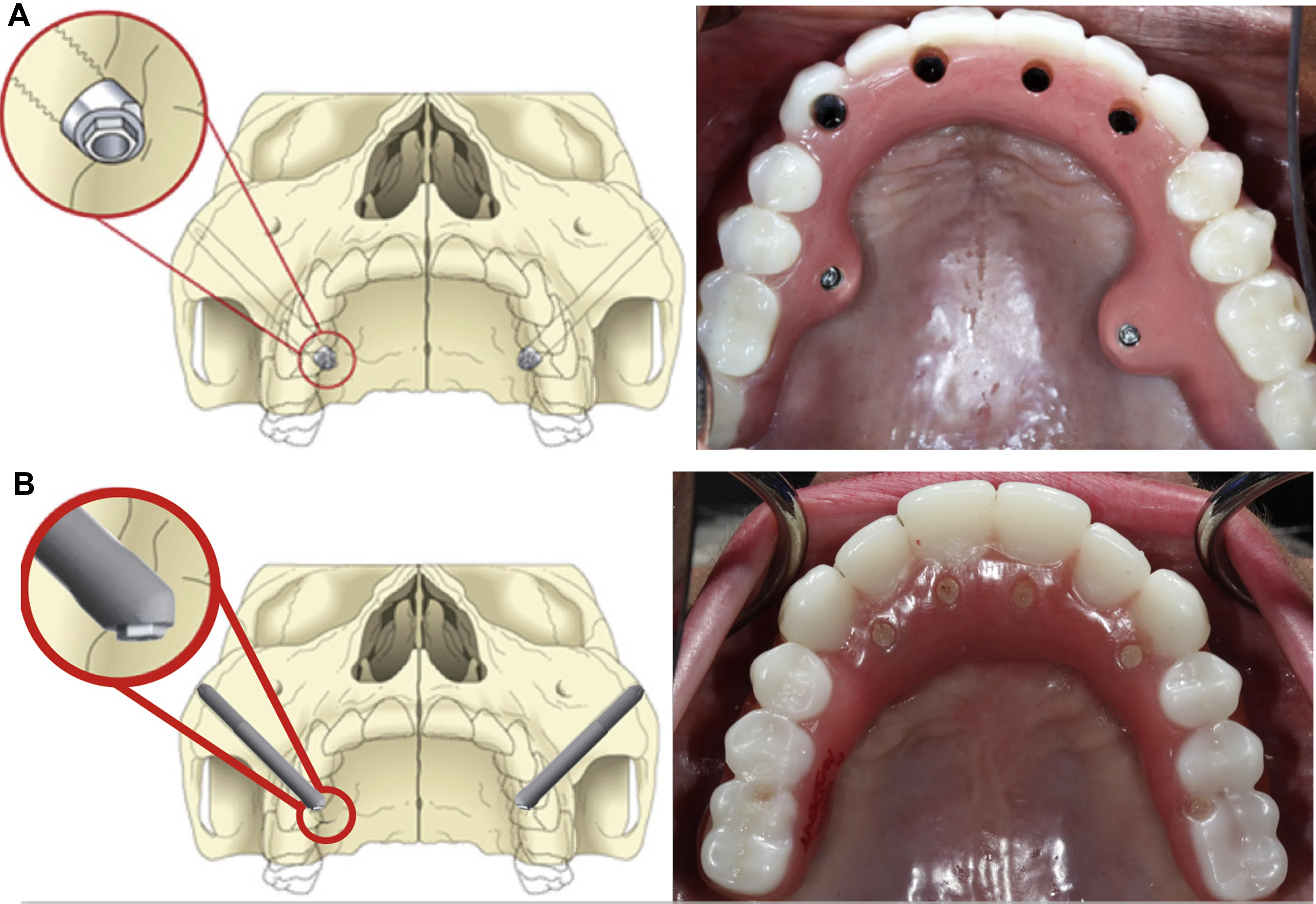 Zygomatic Implants: A Lifesaving Solution for 