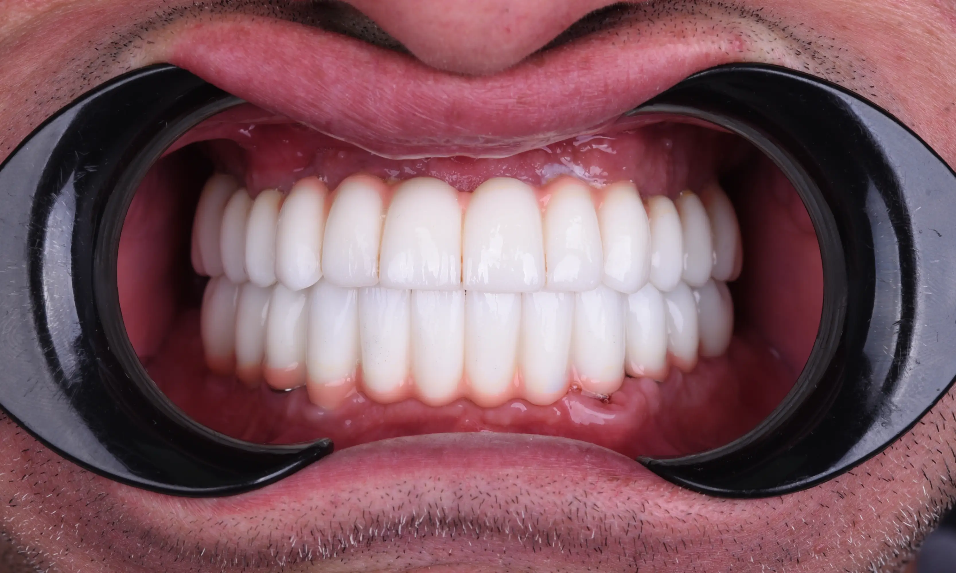 All on X After - Case 12 - Milim Dental Hospital Bursa