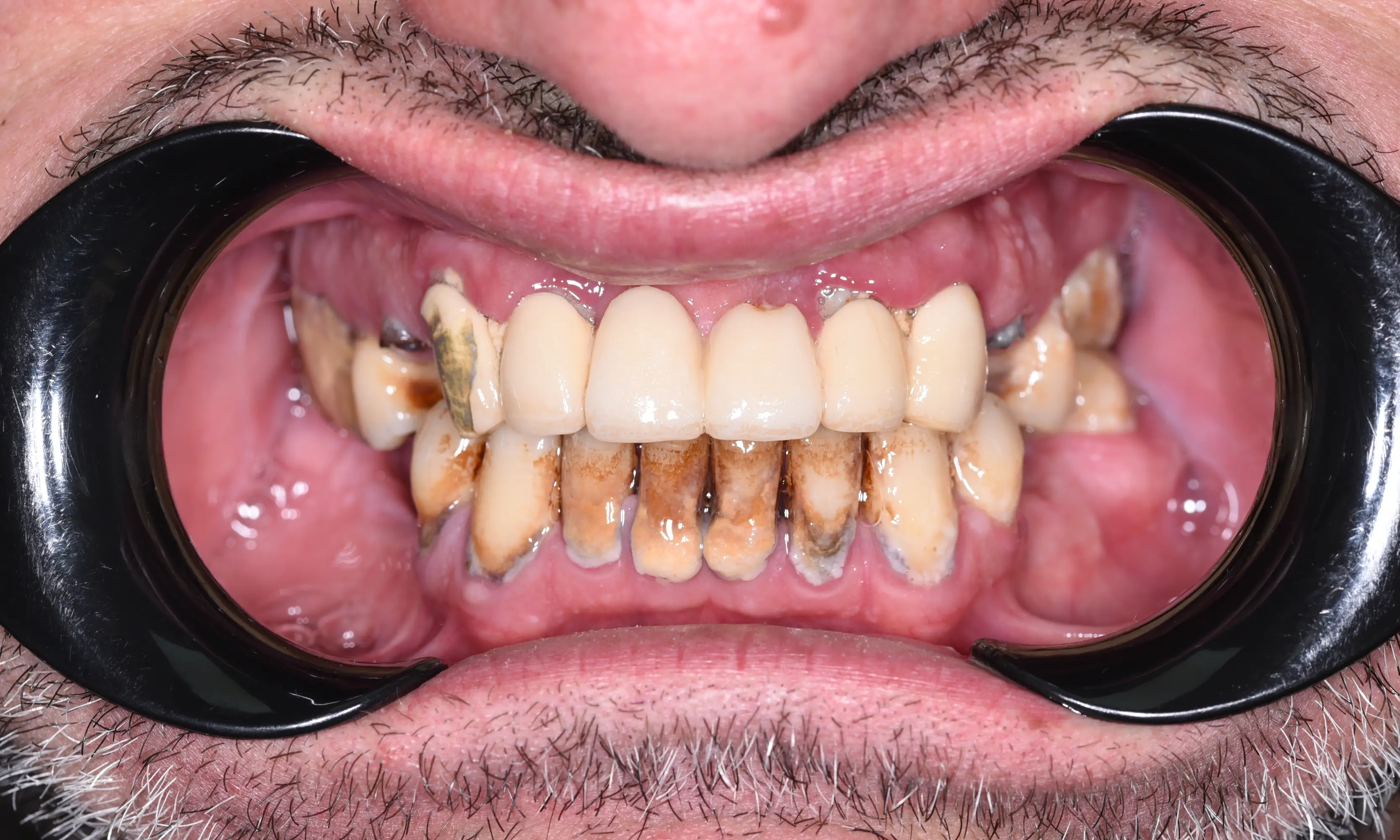 All on X Before - Case 12 - Milim Dental Hospital Bursa