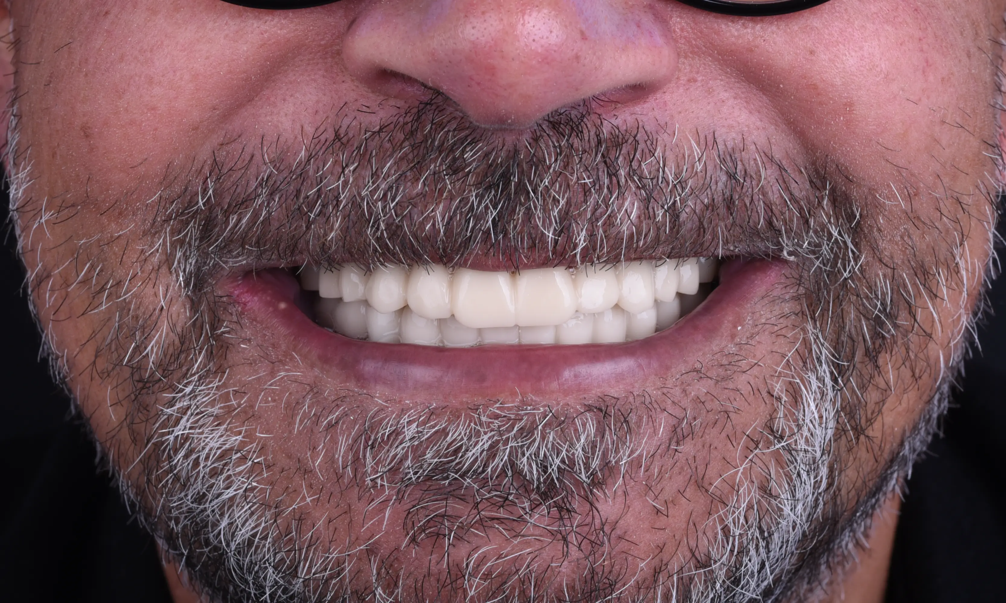 All on X After - Case 14 - Milim Dental Hospital Bursa
